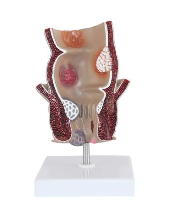 Medical Science Rectum Fissure Lesion Model 5X Human Anorectal Pathology Model Hemorrhoid Anal Fistula School Educational Teaching Accessory Part