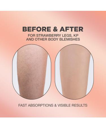 Buy Strawberry Legs Treatment - Exfoliating Body Serum for Women | Effective Chicken Skin Solution - Buy Online on GoSupps.com