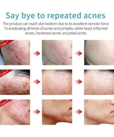 Crema Para El Acne ELIMINA Barros Espinillas Y Manchas RECUPERA Tu Piel LINDA - Buy Online on GoSupps.com