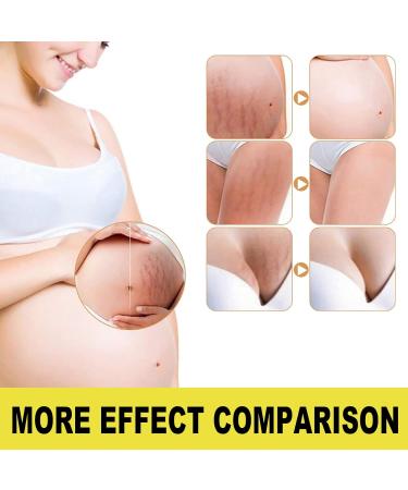 Best Stretch Marks Cream for Scar Removal | Repair & Reduce Skin Stripes - 30g - Buy Online on GoSupps.com