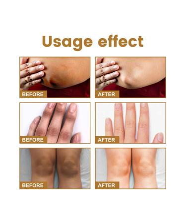 GFOUK Acanthoclear Therapy Spray - Dark Spot Corrector for Black Skin (1PCS) - Buy Online on GoSupps.com