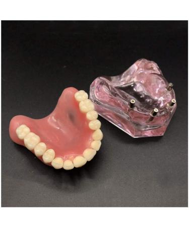 Vinbcorw Dental Model - Maxilla Mini 4 Implant Screws for Mobile Prosthesis Repairs | Removable Pink Design - Buy Online on GoSupps.com