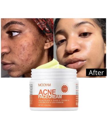 Acne Spot Treatment Cream for Acne 100g AHA BHA Lactic Acid & Zinc Scar Pimple Cream for Face Anti-Blemish Care  - Buy Online on GoSupps.com