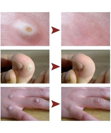 15ml Corn and Wart Remover Liquid for Feet - Callus and Cuticle Removal Treatment - Buy Online on GoSupps.com