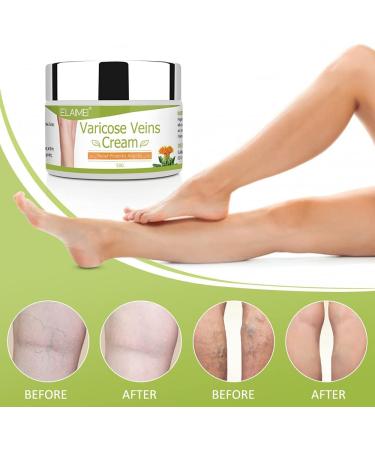 Varicose Veins Cream - Eliminate Varicose & Spider Veins Relieve Heaviness & Phlebitis | Improve Leg Appearance - 2PCS - Buy Online on GoSupps.com