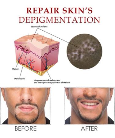 QIMIAN Vitiligo Treatment Spray - Reduces White Spots on Skin - Skin Repair Relief Spray - Pack of 2 - Buy Online on GoSupps.com