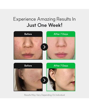 NEUL20S Centelsome 5X Soothing Serum 1.69 fl oz/50ml | for Hydration Glow Sensitive Anti Aging Acne treatment for Face Korean Skincare with Centella Asiatica Exosomes for Skin Panthenol - Buy Online on GoSupps.com