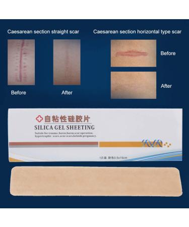 Silicone Scar Sheet - Advanced Self Adhesive for All Skin Types - Ultra-Thin Concealer Surgical Burn Sticker - Buy Online on GoSupps.com