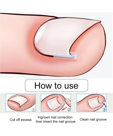 Corrective for Ingrown Nails Correction of Ingrown Nails Correction Kit 30 Pieces Correction Strips for Ingrown Nails Toe Nail Correction - Buy Online on GoSupps.com