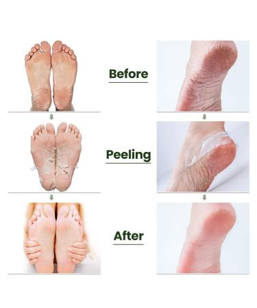 Tea Tree Foot Peel Mask - Exfoliating Treatment for Callused and Cracked Heels - 2 Pack - Buy Online on GoSupps.com