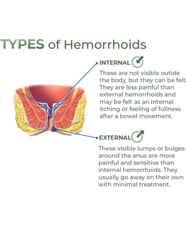 EXQST Heca Natural Herbal Hemorrhoid Capsules - Fast Relief (7 Capsules/Box) - Buy Online on GoSupps.com