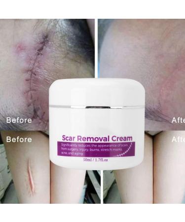 Scar Removal Cream with Plant Extract Stretch Marks & Scars Repair Gel 50ml for Fading Scar and Remove Stretch Marks - Buy Online on GoSupps.com