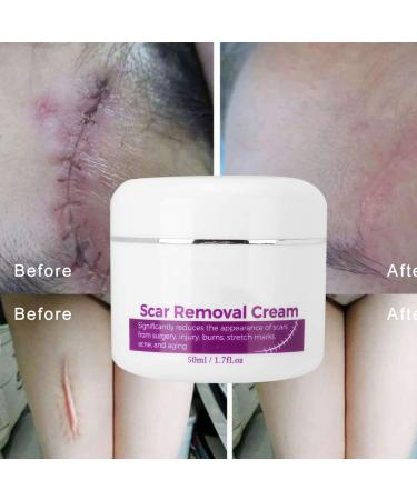 Effective Stretch Marks & Scar Removal Cream | Skin Repair Formula for All Skin Types - Buy Online on GoSupps.com