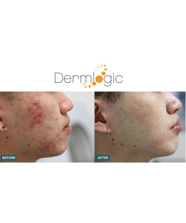 Buy 5% Benzoyl Peroxide Acne Treatment Face & Body Wash - Deep Cleansing for Clear Skin - Prevent Zits & Pimples | International Shipping Available - Buy Online on GoSupps.com