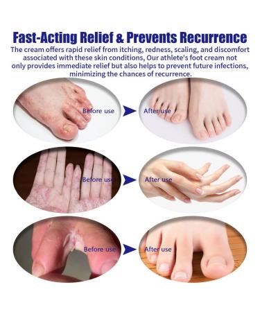 Antifungal Cream for Itchy Feet Relief - Jock Itch, Foot Odor, Ringworm, Psoriasis, Eczema, Rash - Athlete's Foot Treatment - Fast Relief - 1.76 Oz (Pack of 1) - Buy Online on GoSupps.com
