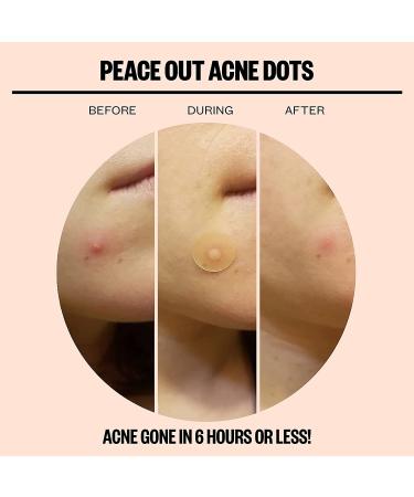 PEACE OUT Jumbo Acne Healing Dots - Fast-Acting Anti-Acne Patches with Salicylic Acid (40 Dots) - Buy Online on GoSupps.com