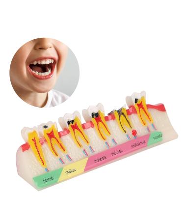 Teeth Model for Dental Education | Portable Dental Caries Development Model for Courses - Buy Online on GoSupps.com