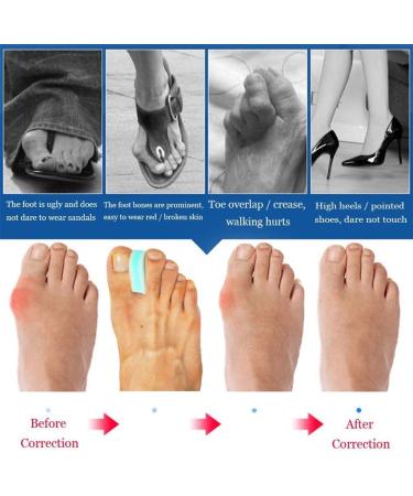 Mcvcoyh 3-Layer Foam Toe Spacer & Bunion Corrector - 8 PC Set for Bunions Pain Relief (Soft & Lightweight) - Align & Separate Toes - Buy Online on GoSupps.com