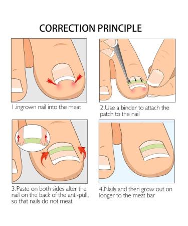 Ingrown Toenail Corrector Strips - 10pcs Bottle, Straightener Clip for Thick Toenails - Foot Tool for Correction - Buy Online on GoSupps.com