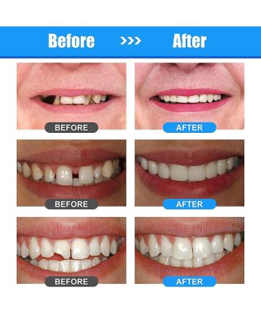 Temporary Tooth Filling Repair Kit with Professional Tools - Tooth Repair Granules for Missing Teeth | Tooth Replacement & Repair - Buy Online on GoSupps.com
