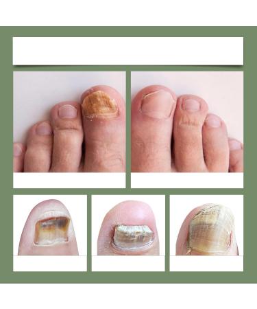 Lot de 4 stylos r parateurs d'ongles de qualit sup rieure - Traitement des ongles des orteils - Avec ingr dients naturels - S rum de soin des ongles pour les ongles endommag s s rs et efficaces pour 4 pi ces - Buy Online on GoSupps.com