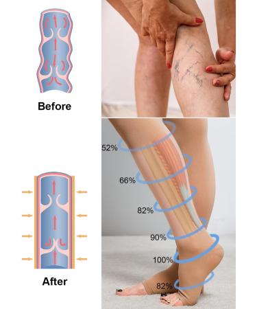 Buy Medical Compression Stockings 20-30 mmHg for Women & Men - Varicose Veins & Edema Support - XXL Black + Beige - Open Toe Sparkle Design - Buy Online on GoSupps.com