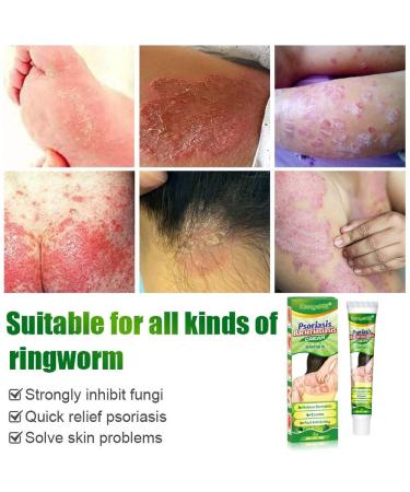 Psoriasis and Eczema Relief Cream - Soothes Dry, Itchy, and Inflamed Skin - Pack of 1 - Buy Online on GoSupps.com