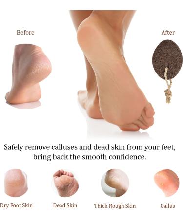 Pumice Stone for Feet Callus Remover - Natural Lava Foot Scrubber for Dead Skin Removal - Exfoliating Stone for Dry Cracked Heels & Hands - Buy Online on GoSupps.com