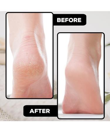 Pedicure Foot File for Hard Skin Removal | Metal Surface Dead Skin Remover Rasp | Callus Scraper for Feet - 1 Count - Buy Online on GoSupps.com