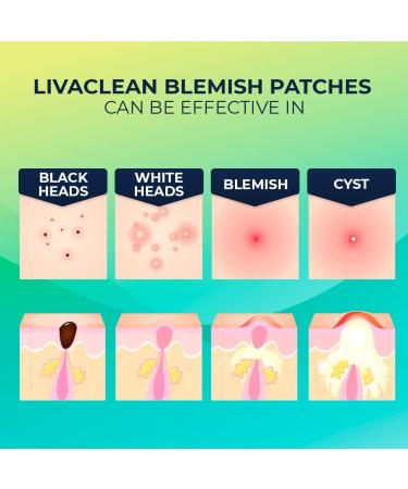 Livaclean (240 Count 6 Pack) Mixed bundle of Regular (96) Salicylic Acid (72) and T.Tree (72) Hydrocolloid Patches 6 Pack - 240 Count - Buy Online on GoSupps.com