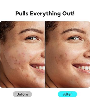 XFSRG 302 large patches of pimples with tea tree oil of salicylic acid and niacinamide for large pimples on chin cheeks back Transparent1 - Buy Online on GoSupps.com