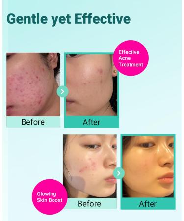 BRING GREEN TEA TREE CICA SET | Korean Skin Care Kit for Acne-Prone, Sensitive Skin | Zinc Teca Serum, Tea Tree Hydrating Moisturizer & Deep Cleansing Foam | Oil Control & Pore Care | K-Beauty Gift SOOTHING TRIO SET - Buy Online on GoSupps.com