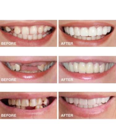  2 Pairs Comfortable Temporary Smile Restore Confidence with Natural Look Temporarily Adjustable for Men and Women Teeth Whitening Kits (1) - Buy Online on GoSupps.com