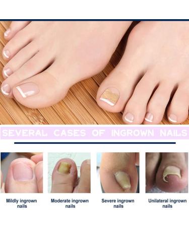 200 Pieces Ingrown Toenails Stickers Toenail Correction Patch Glue-Free Ingrown Curved Toenail Lifter Foot Care Treatment Pedicure Tool (A) - Buy Online on GoSupps.com