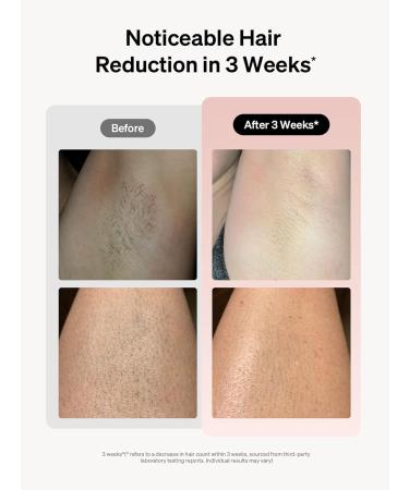 Ulike Laser Hair Removal for Women Long-Lasting IPL Hair Removal Device with Ice-Cooling Technology for Nearly Painless Treatment for Facial Bikini & Whole Body Pink - Buy Online on GoSupps.com