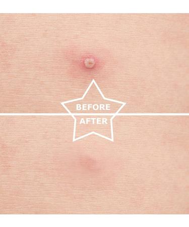 Zuofan Pimple Patch 18 Units Pimple Acne Patches Anti-Acne Pimple Patch Absorbent Hydrocolloid Effective Anti-Acne Treatment Patch Invisible Skin Care Patch - Buy Online on GoSupps.com