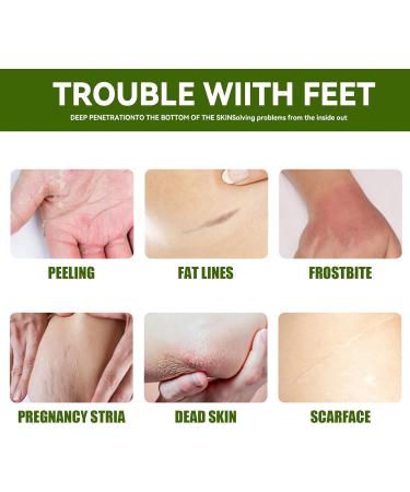 Maximum Strength 42% Urea Foot Cream Callus Remover for Dry, Hard Skin - Cracked Heel Repair 50g - Buy Online on GoSupps.com