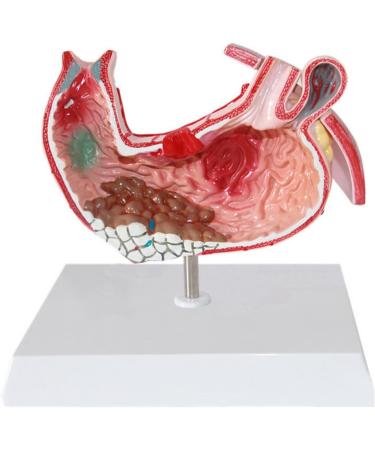 Human Stomach Lesion Model with Diaphragm Model Digestive System Model gastric Ulcer Model - Buy Online on GoSupps.com
