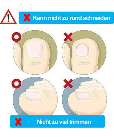 Ingrown Toenail Correction Patch - Glue-free Toe Nail File Paronychia Corrector - 4 Sizes - Foot Care Treatment Pedicure Tool - Buy Online on GoSupps.com