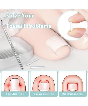 KINDOYO Correction Ingrown Toenails Set - 40 Pieces Painless Toenail Smoothing Strips with Toenail Lifter - Simple Tool Set for Ingrown Toenails - Buy Online on GoSupps.com