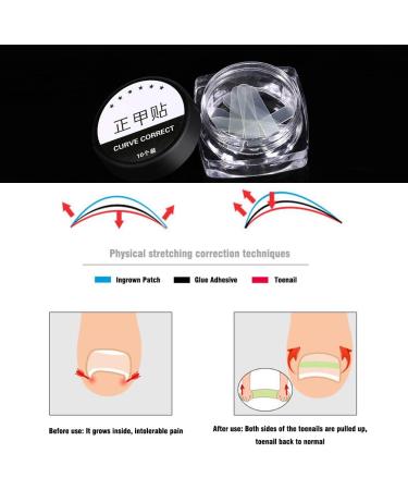 10Pcs/Box Toenail Correction Ingrown Sticker Patch Toe Nail Fixer Recover Pedicure Tool Super Thin Design for Comfort Strong Toughness Effective Corrector Suitable for - Buy Online on GoSupps.com