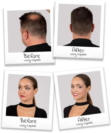 Kapilab Streuhaar Haarfasern Dunkel Braun Haarpuder zur Haarverdichtung - Keratin Ansatzpuder f r D nner Werdendes Haar Frauen und M nner Haarausfall 100% Nat rlich 5 gramm - Buy Online on GoSupps.com