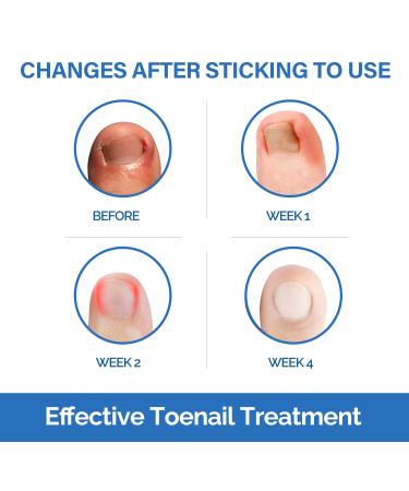 Ingrown Toenail Treatment Kit - 50Pcs No Glue Corrector Patch & Tools - Protect and Repair Ingrown Nails - Buy Online on GoSupps.com