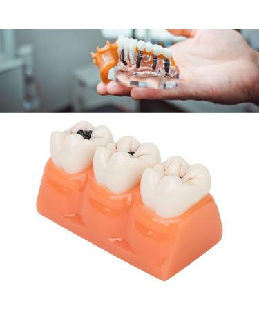 4-Fold Caries Model for Dental Education | Tooth Caries Simulation & Diagnostic Training | Portable for Dentists & Students - Buy Online on GoSupps.com