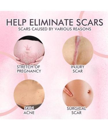 KARLOR Body Oil for Pregnancy Stretch marks Body Oils for Scars Pregnancy Stretch Mark Prevention Skin Care Oil Body Reduce streth makrs scars & Marks form pregnancy injury acne(120ml) - Buy Online on GoSupps.com