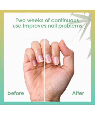 3-Piece Nail Care Pen Set - Fast Nail Fungus Treatment with Tea Tree Oil & Vitamin E for Healthy Fingernails & Toenails - Buy Online on GoSupps.com