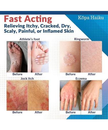 Kopa Haiku Antifungal Herbal Cream - 30g - Buy Online on GoSupps.com