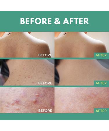 Back Acne Treatment Spray with Salicylic Acid & Tea Tree Oil - Effective Body Acne Solution | Proactive Treatment 4 oz - Buy Online on GoSupps.com