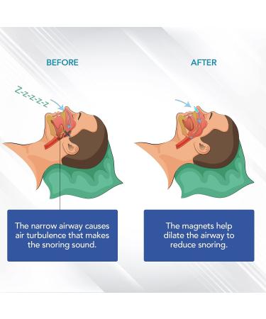 Skyloa Anti Snoring Devices - Stop Snoring and Sleep Better - Buy Online on GoSupps.com