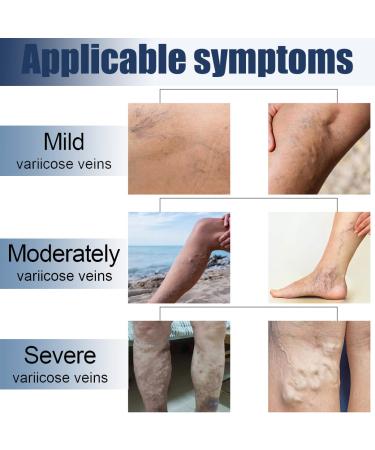 36 Pcs Varicose Veins Patch - Treatment for Legs, Spider Vein Relief - Improve Blood Circulation and Capillary Health - Buy Online on GoSupps.com